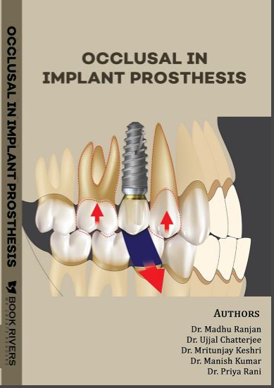OCCLUSAL IN IMPLANT PROSTHESIS