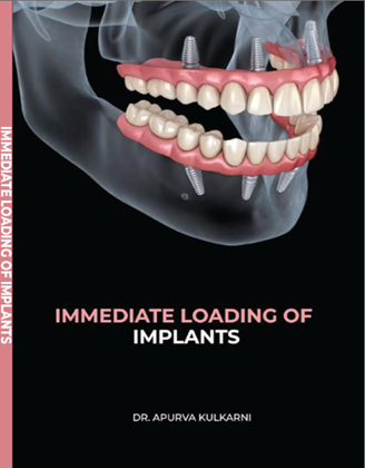 Immediate Loading of Implants