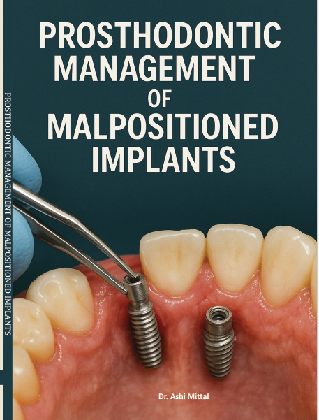 PROSTHODONTIC MANAGEMENT OF MALPOSITIONED IMPLANTS