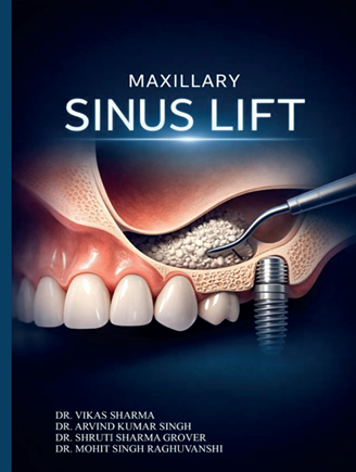 Maxillary Sinus Lift